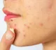 Doctors Recommend Chilling Acne Creams Before Use To Reduce Cancer Risk