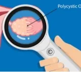 Routine screening key for early detection of ovarian cancer: Experts