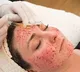 At Least 3 Women Contracted HIV After Getting Vampire Facial At Spa