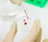 blood test powered by ai could catch osteoarthritis 8 years earlier