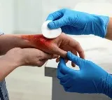 No ice, no toothpaste for burn injuries, say KGMU experts