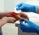 No ice, no toothpaste for burn injuries, say KGMU experts