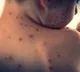 Global measles cases see 88pc jump in 2023 from 2022: WHO