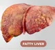fatty liver disease cases up in hyderabad after work from home