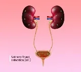 Study shows how E. coli causes urinary tract infections