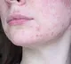 Why autoimmune disorder lupus affect women more than men