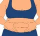 Obesity, metabolic syndrome raises breast cancer-related death risks: Study