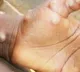 Monkeypox case detected in South Africa