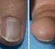 How your nail colour can signal cancer risk