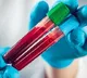 Blood cancer cases may be rising among young adults in India, say experts