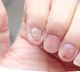 Nails as indicators of underlying health symptoms