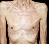 What's 'cancer cachexia' syndrome, a disease behind most patients' death?