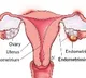 Swiss researchers develop a hydrogel implant to treat endometriosis