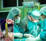 Doctors Remove Bottle Gourd From Man Stomach
