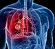 Lung cancer is most common cancer to spread to brain: Experts