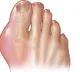 CSIR-NBRI develops herbal remedy to improve gout symptoms in elderly