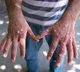 WHO declares Mpox a Global public health emergency
