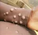 China tightens precautions at ports as global mpox cases increase