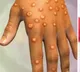 Monkeypox virus reaches to Pakistan