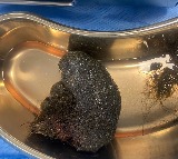 Bengaluru doctors remove cricket ball-sized hairball from 8-year-old’s stomach