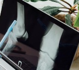 Dietary deficiency major risk factor for osteoporosis in women: Experts