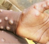 Africa CDC warns of rising mpox cases as death toll reaches 643