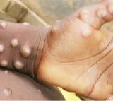 Africa CDC warns of rising mpox cases as death toll reaches 643