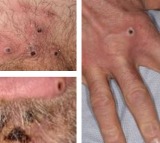 WHO prequalifies Bavarian Nordic’s vaccine against Mpox