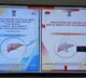 Union Health Ministry releases new guidelines for non-alcoholic fatty liver disease