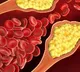 How high cholesterol, microplastics are contributing to rising heart diseases