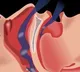 Australian research finds link between snoring, elevated blood pressure