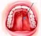 Smokeless tobacco, betel nut drive oral cancer cases in India, highest in South Asia: Lancet