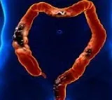 Study shows how stress worsens colorectal cancer