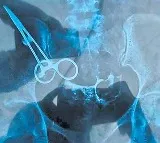 two scissors in womans abdomen for 12 years