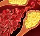 Covid infection spiked high cholesterol risk by 30pc: Study