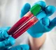 Blood-biomarker tests may aid in early diagnosis of Alzheimer’s: Report