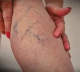 25 per cent of Indians affected by Varicose Veins, say health experts