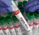 US confirms first case of clade I mpox in California