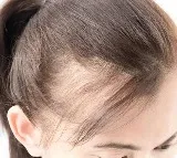 Women Suffering From Traction Alopecia