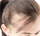 Women Suffering From Traction Alopecia
