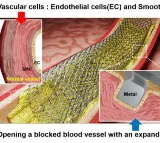 New laser patterning tech to revolutionise stent surgery for heart diseases