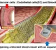 New laser patterning tech to revolutionise stent surgery for heart diseases