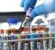are you know about chloride blood test