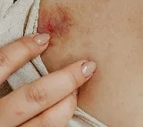 high cholesterol signs that show on skin