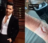 Varun Dhawan suffers injury, shows off deep cut on his finger
