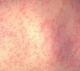 Measles outbreak spreads in US