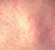 Measles outbreak spreads in US