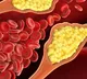 Reduce your bad cholesterol levels to keep Alzheimer’s, dementia at bay