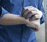 Heat Rash in Summer: How to Prevent and Soothe Prickly Heat