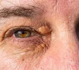 Cholesterol Detect High Cholesterol Levels by Examining Your Eyes